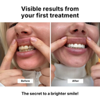 WHITR Instant Whitening Strips